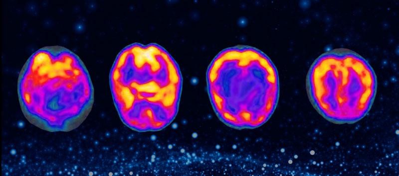 SPECT SCANS – CAN THEY BE RELIED ON TO DIAGNOSE A TRAUMATIC BRAIN INJURY?